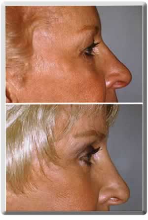 upper and lower eyelid lifts in ft. lauderdale - eyelid surgery before and after